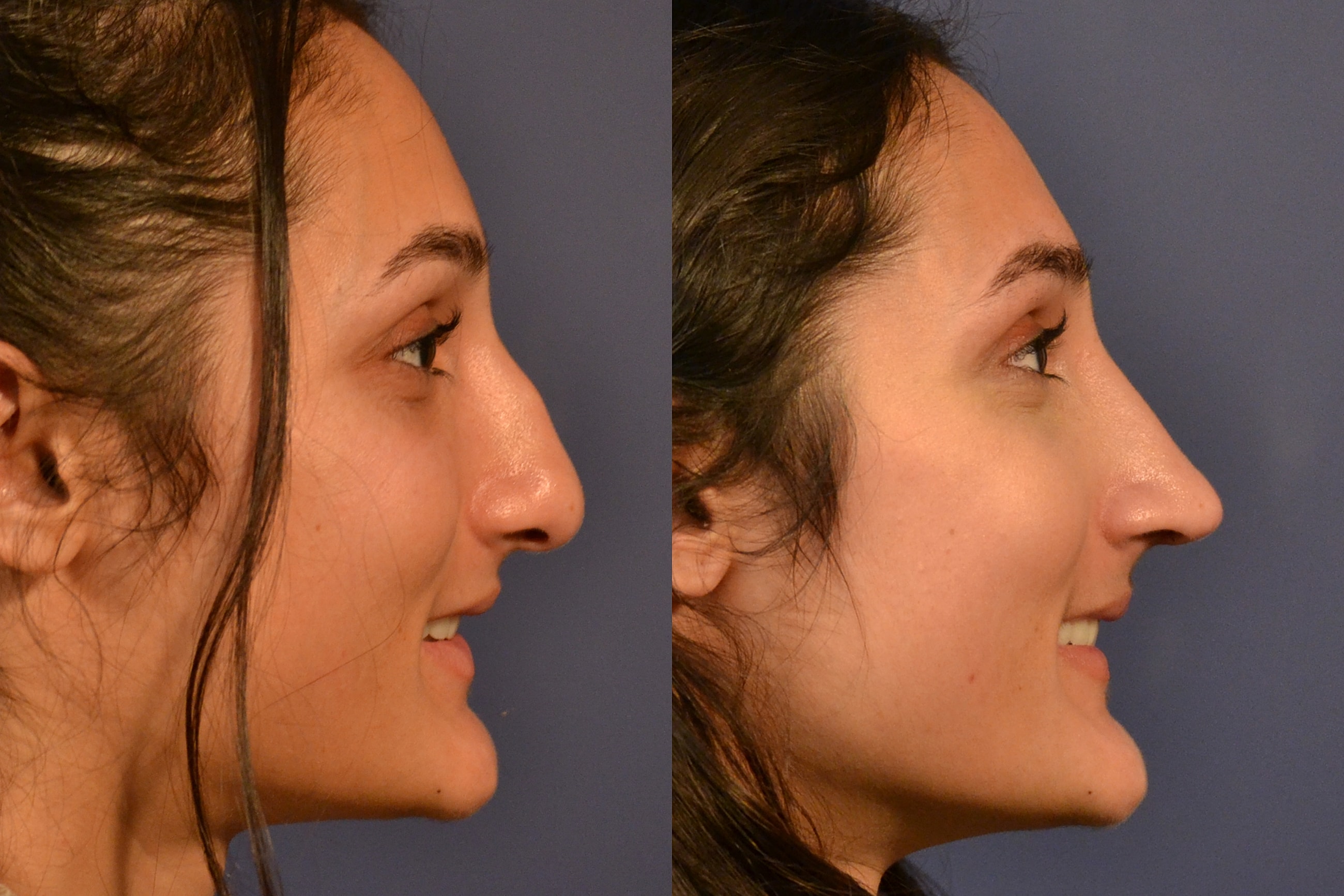 Before and after nose profile comparison.
