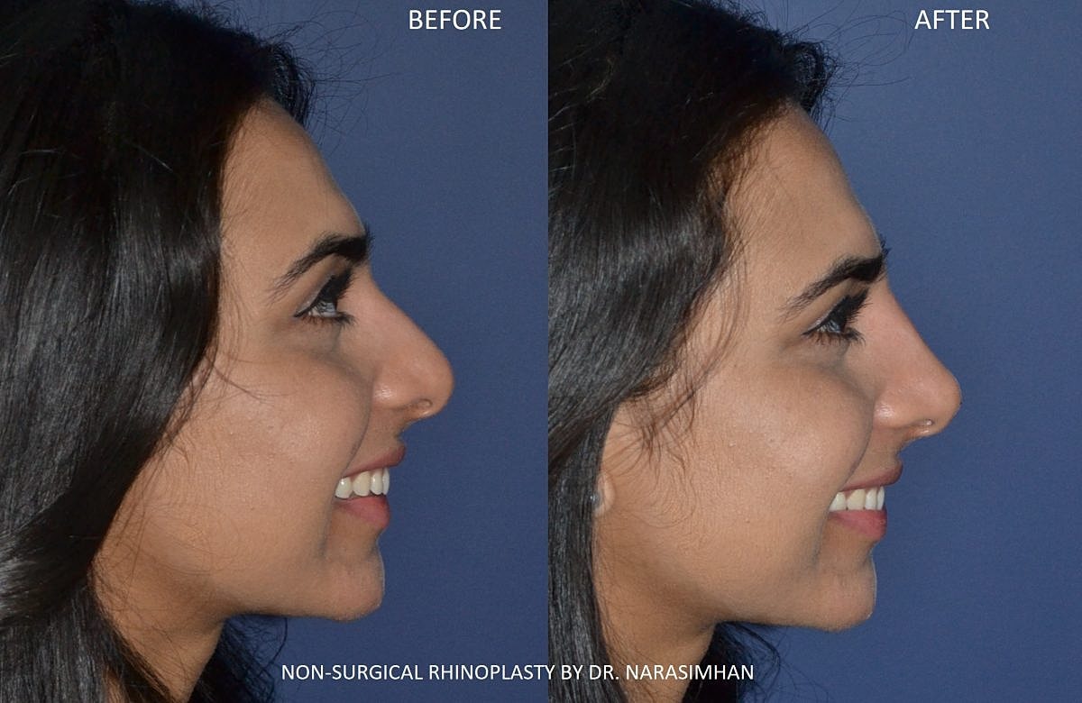 How Long does Non Surgical Rhinoplasty Last?