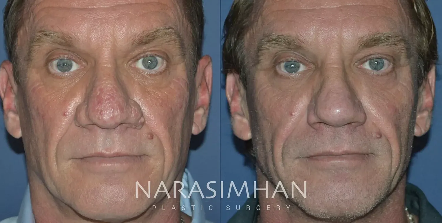 Rhinophyma Removal Before & After