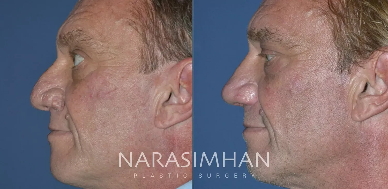 Rhinophyma Removal Before & After