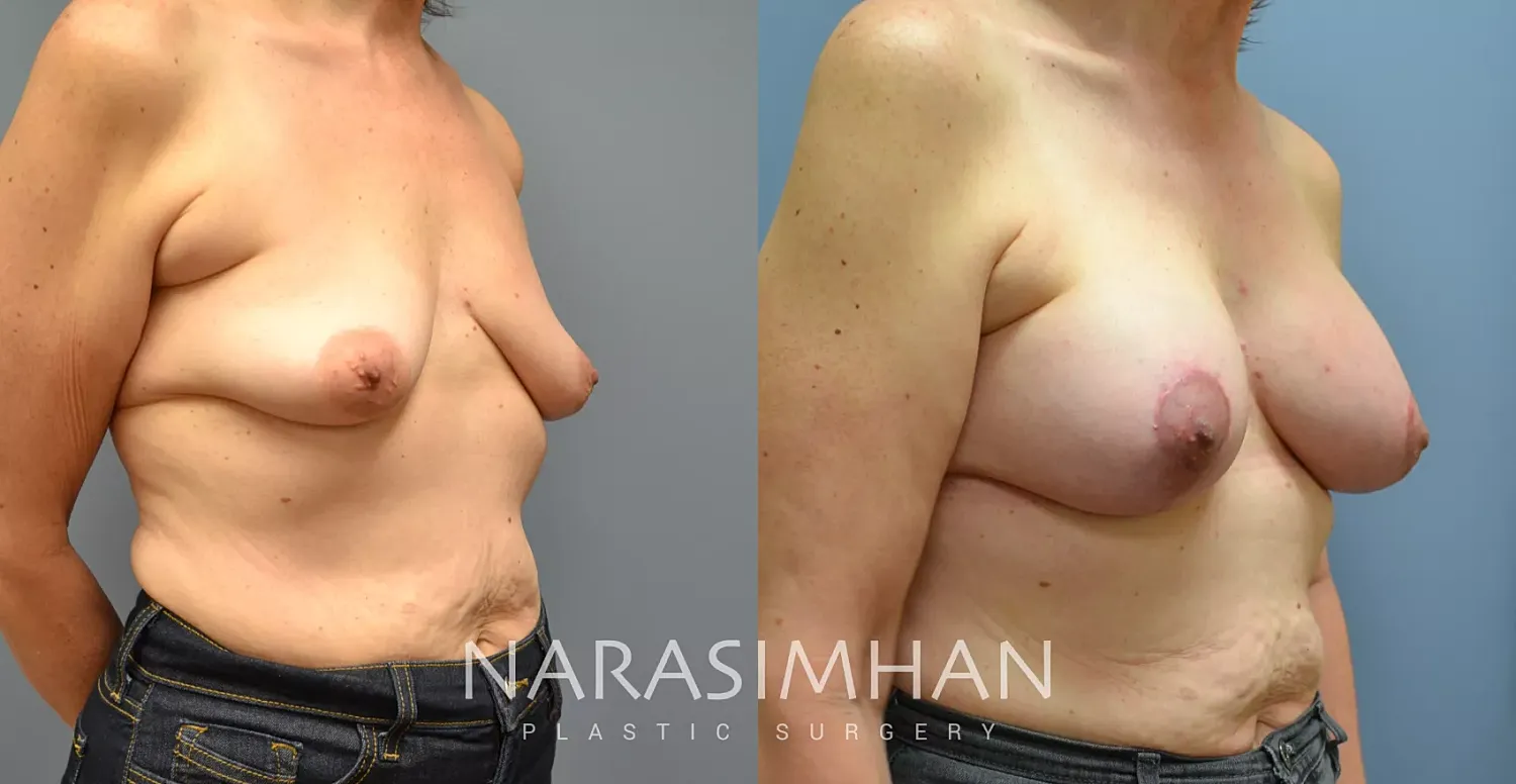 Breast Lift Mastopexy Before & After