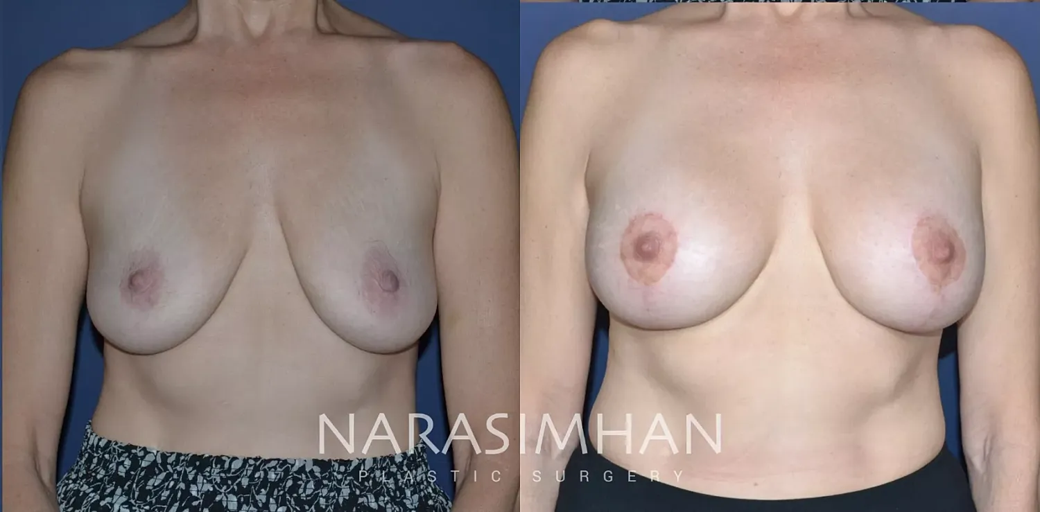 Breast Lift Mastopexy Before & After