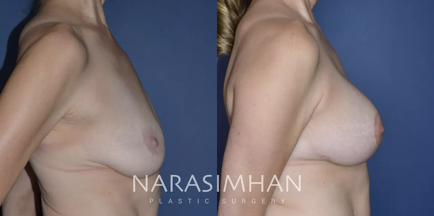 Breast Lift Mastopexy Before & After