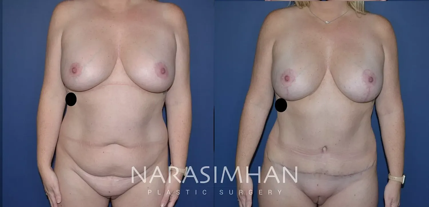 Breast Lift Mastopexy Before & After