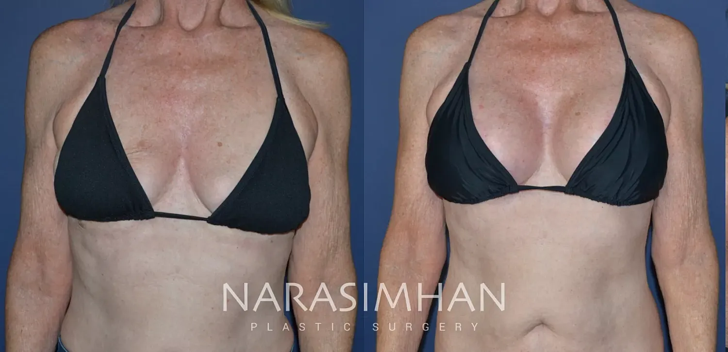 Breast Lift Mastopexy Before & After