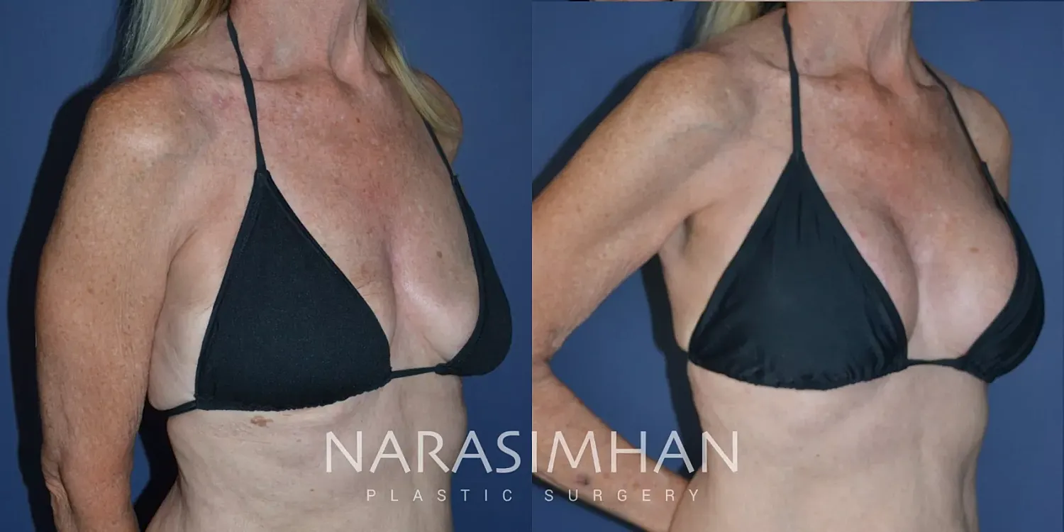 Breast Lift Mastopexy Before & After