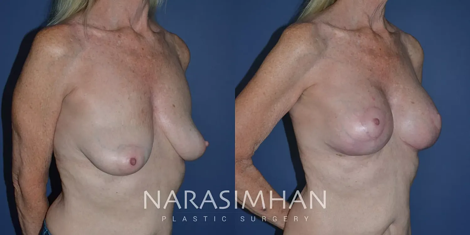 Breast Lift Mastopexy Before & After