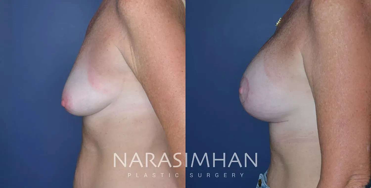 Breast Lift Mastopexy Before & After