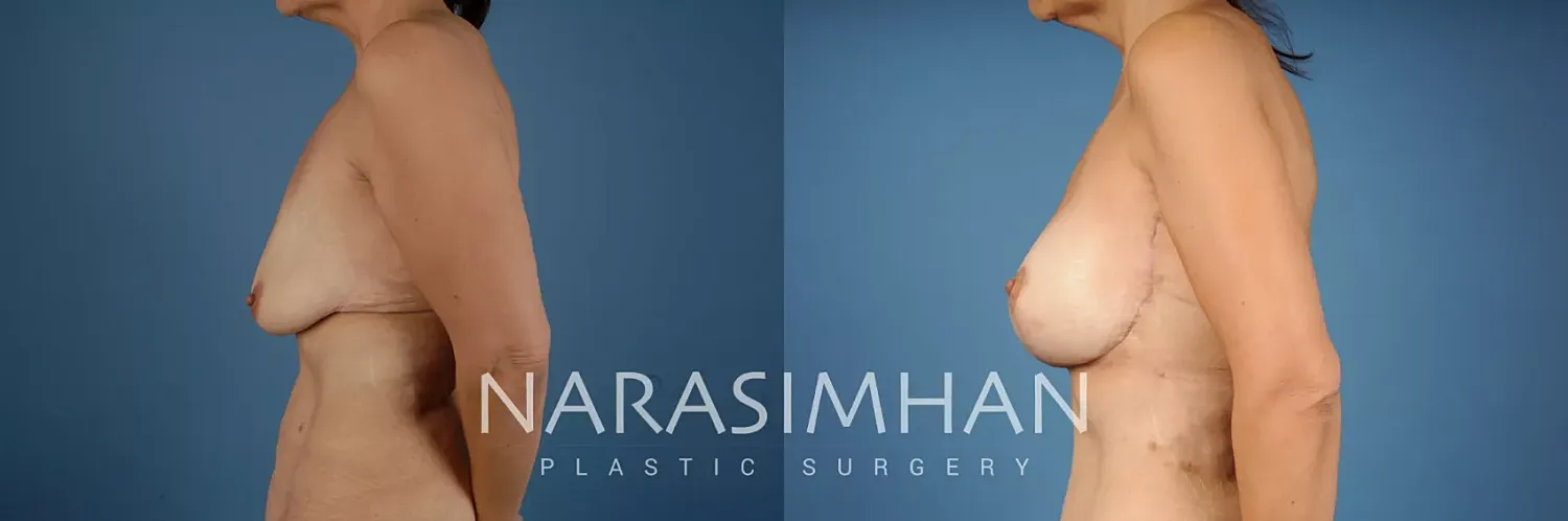 Breast Lift Mastopexy Before & After