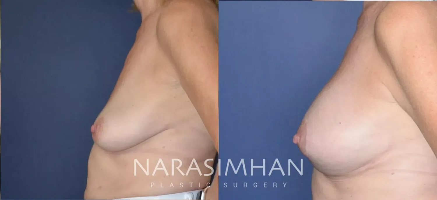 Breast Lift Mastopexy Before & After