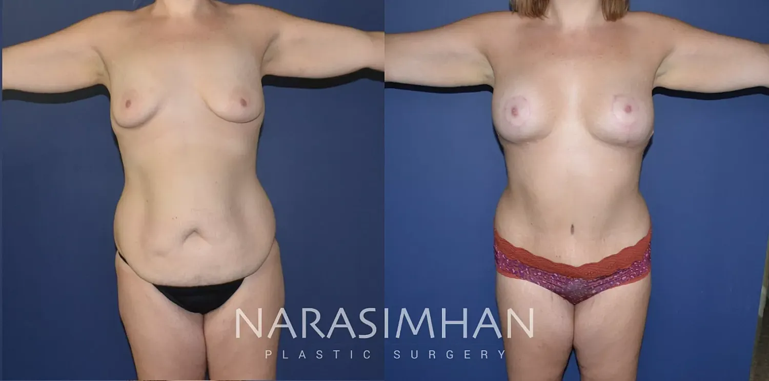 Breast Lift Mastopexy Before & After