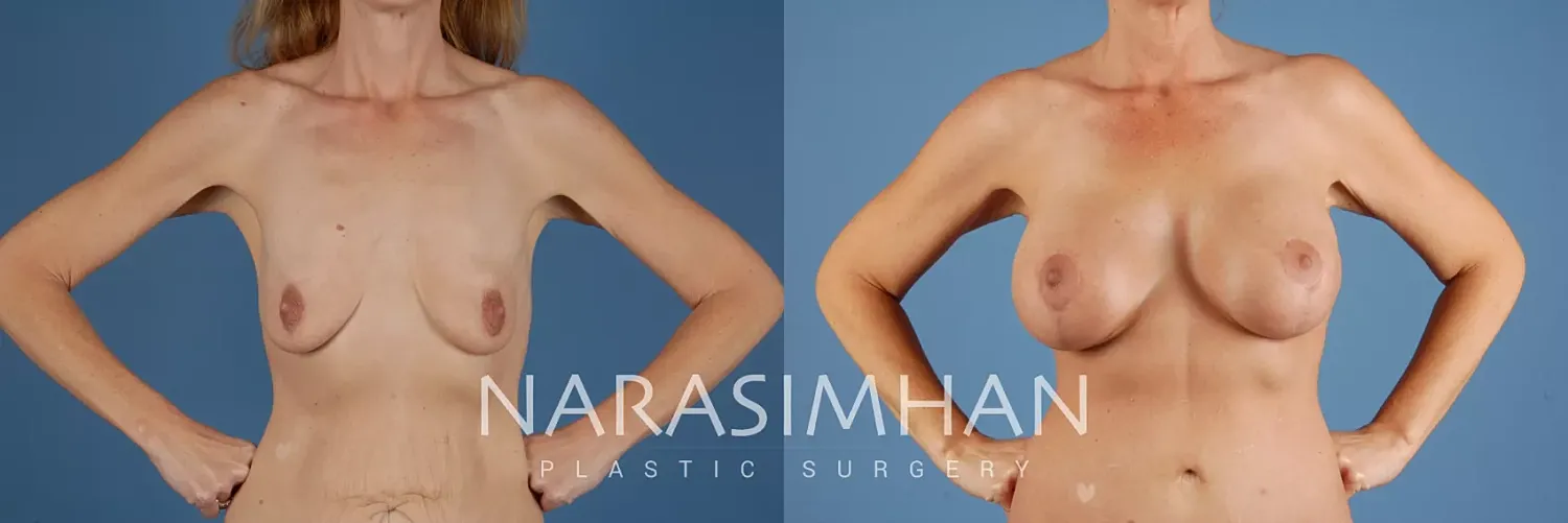 Breast Lift Mastopexy Before & After