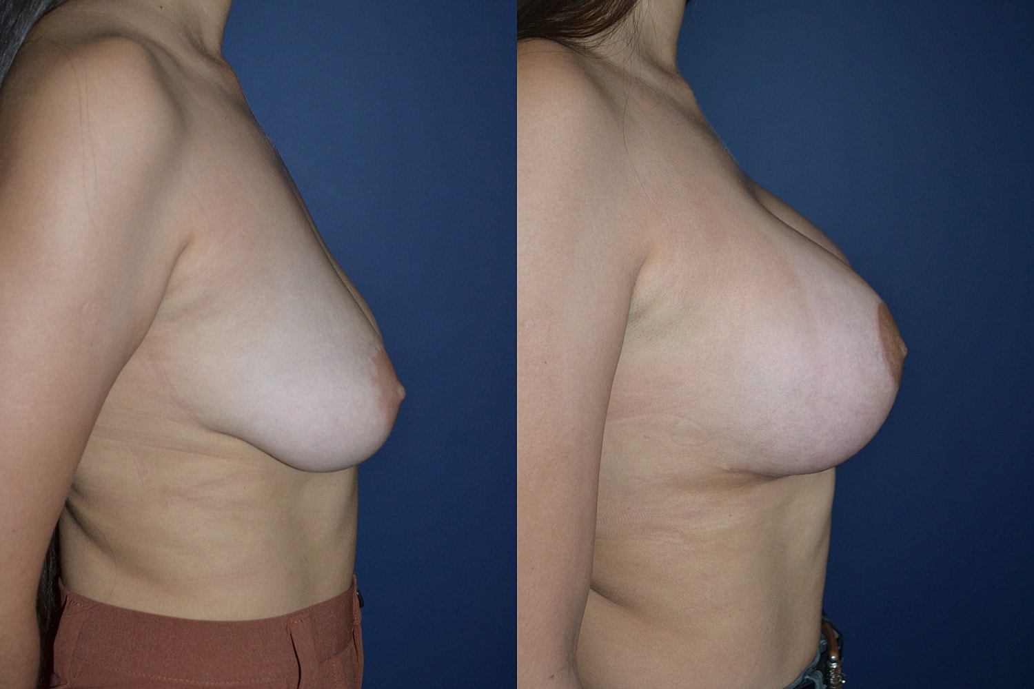 Breast Augmentation + Lift Before & After