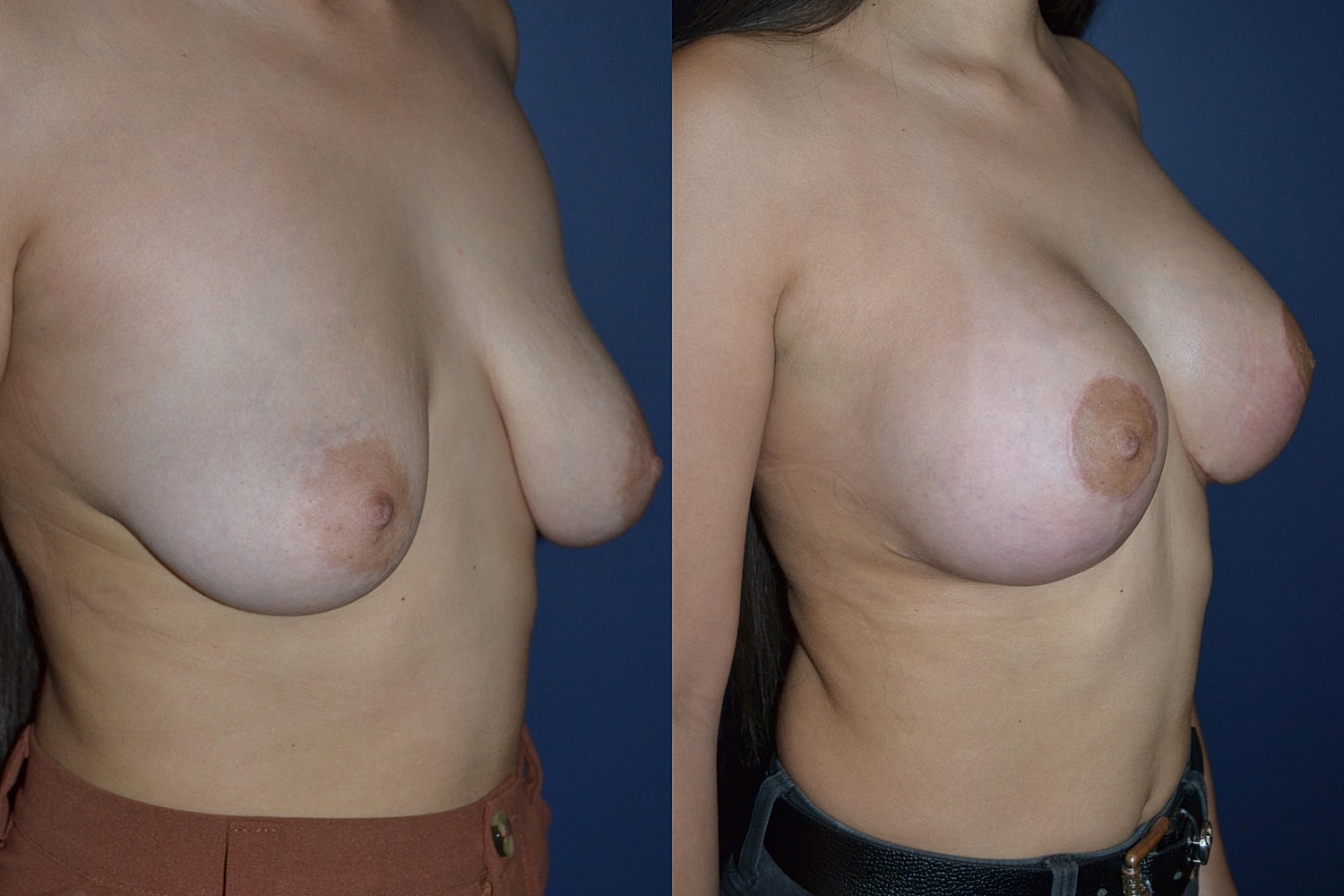 Breast Augmentation + Lift Before & After