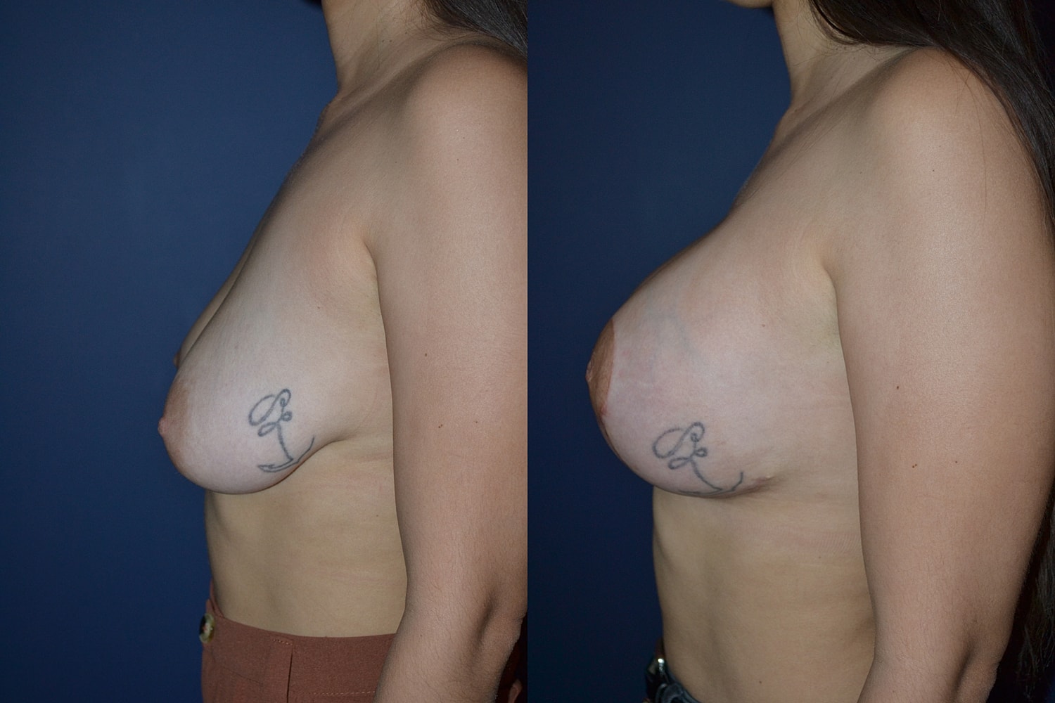 Breast Augmentation + Lift Before & After