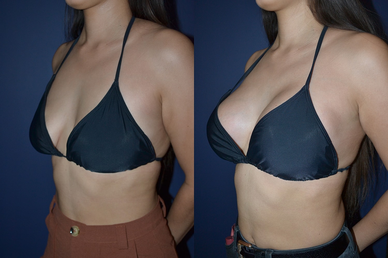 Breast Augmentation + Lift Before & After