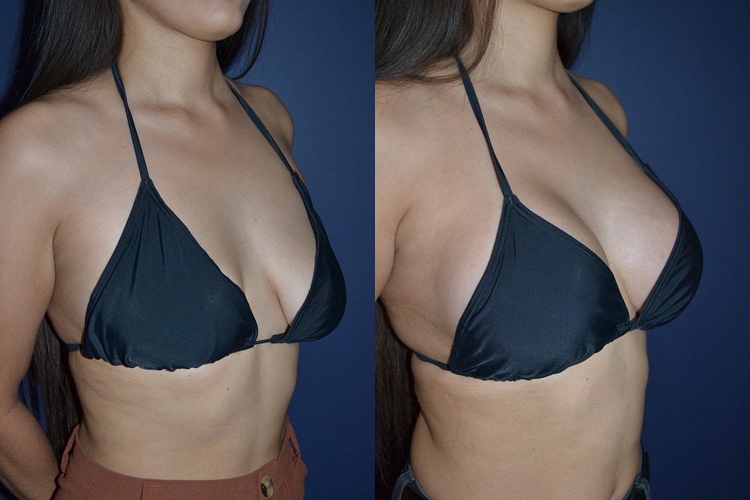Breast Augmentation + Lift Before & After