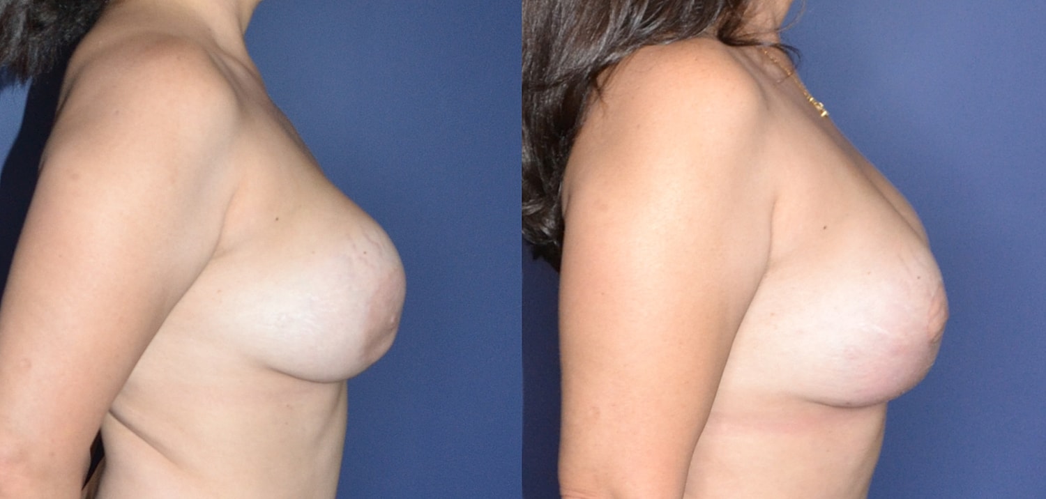 Breast Augmentation + Lift Before & After