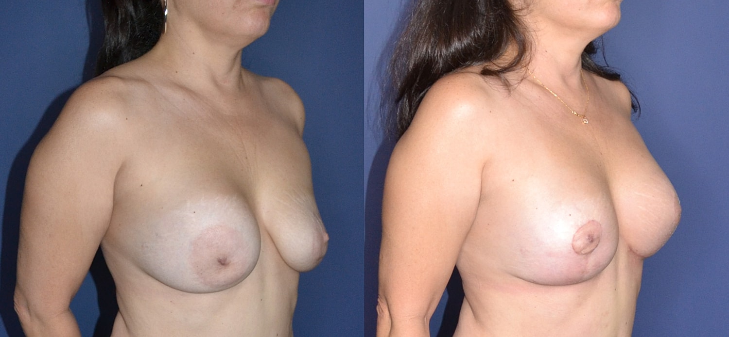 Breast Augmentation + Lift Before & After