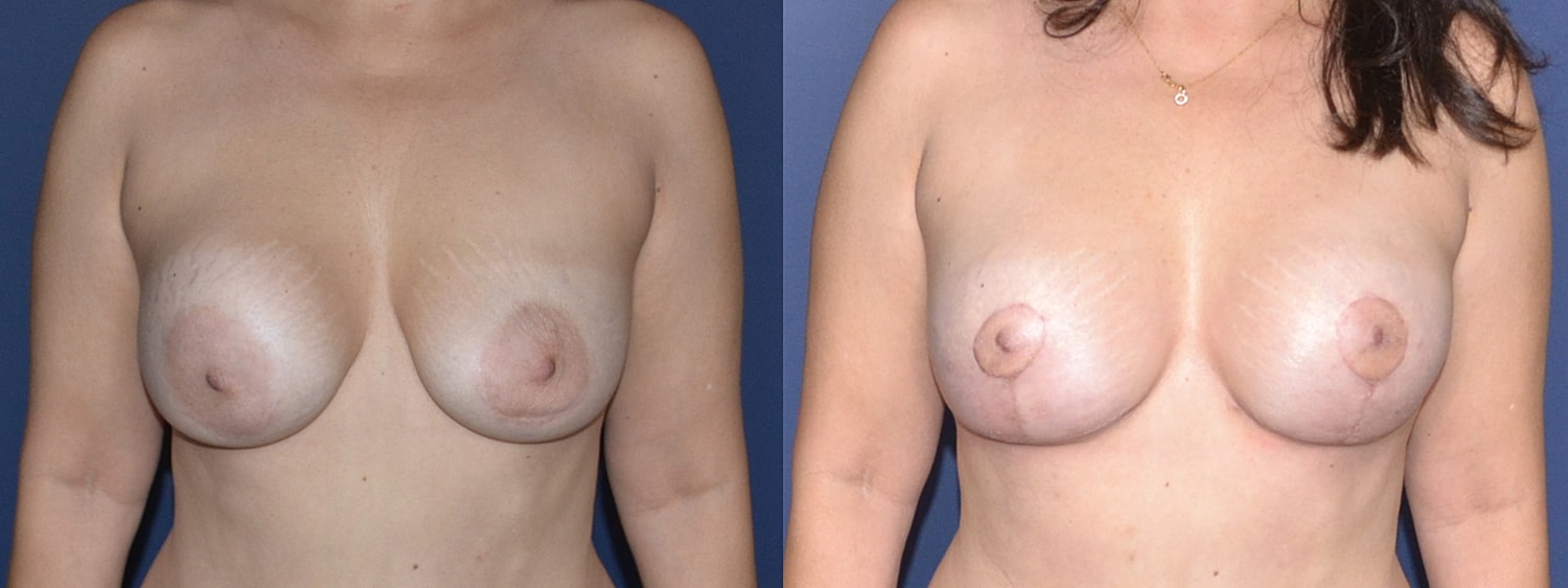 Breast Augmentation + Lift Before & After