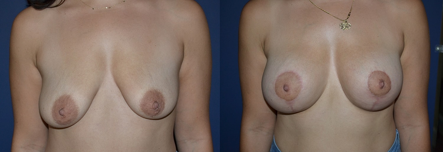 Breast Augmentation + Lift Before & After