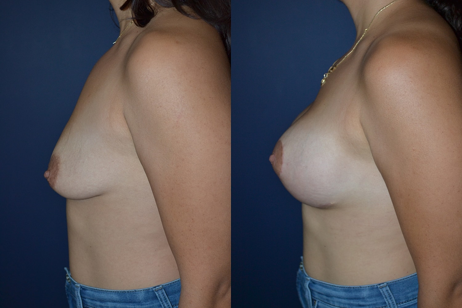 Breast Augmentation + Lift Before & After