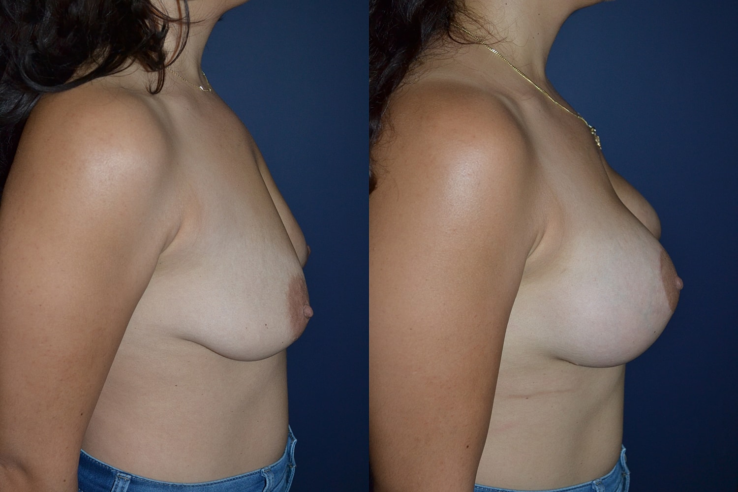 Breast Augmentation + Lift Before & After