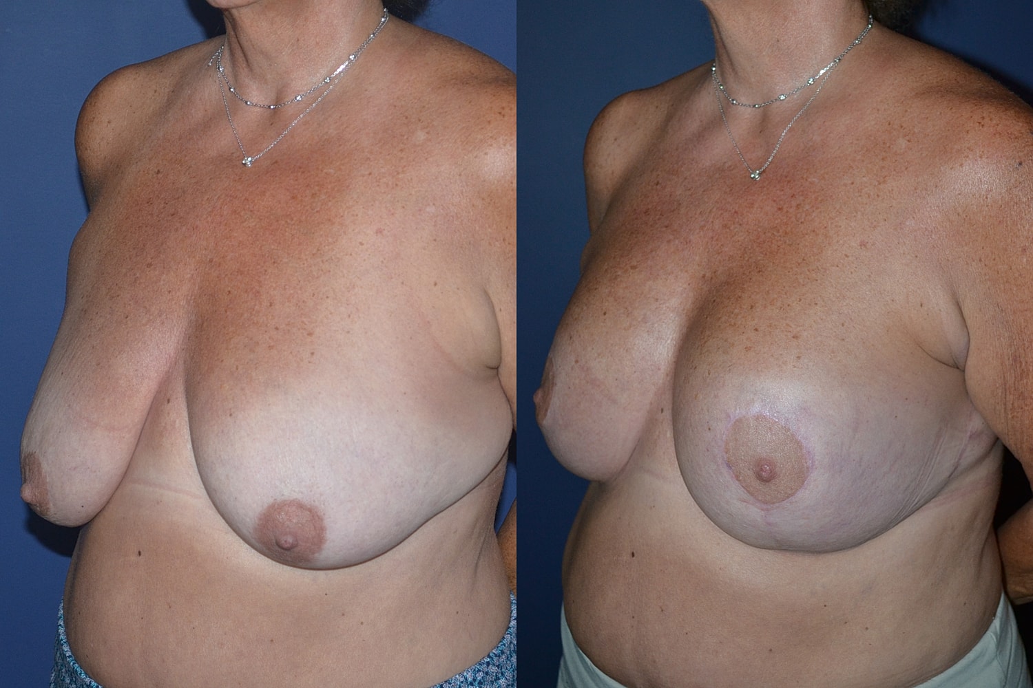 Breast Augmentation + Lift Before & After