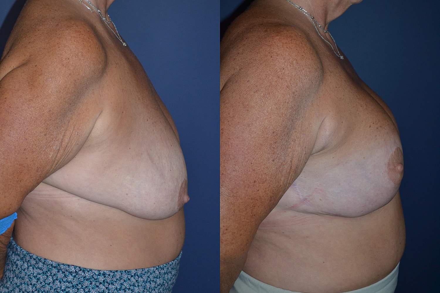 Breast Augmentation + Lift Before & After