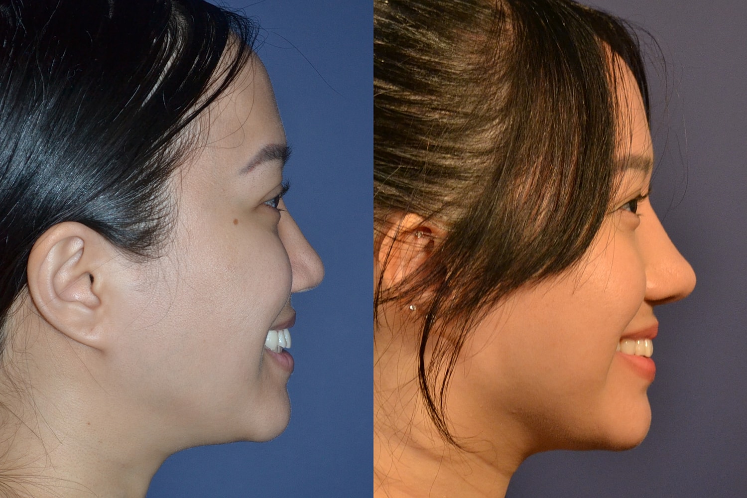 Profile comparison of a person's face before and after.