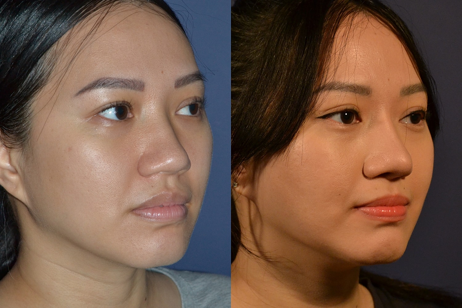 Before and after cosmetic enhancement comparison.