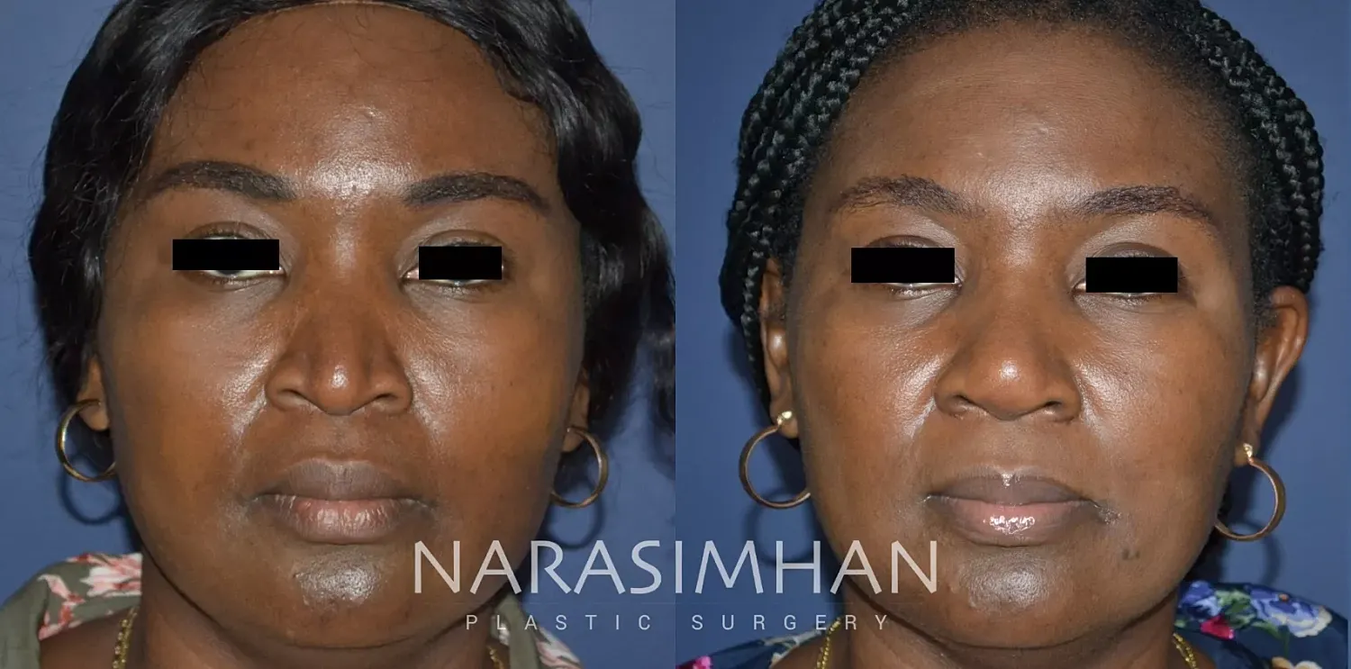 Ethnic Rhinoplasty Before & After