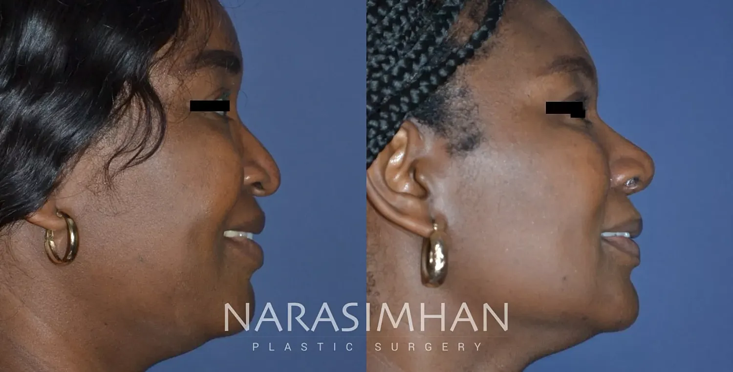 Ethnic Rhinoplasty Before & After