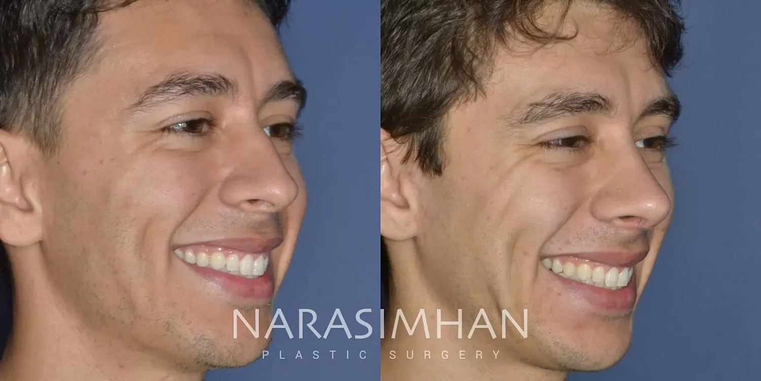 Ethnic Rhinoplasty Before & After