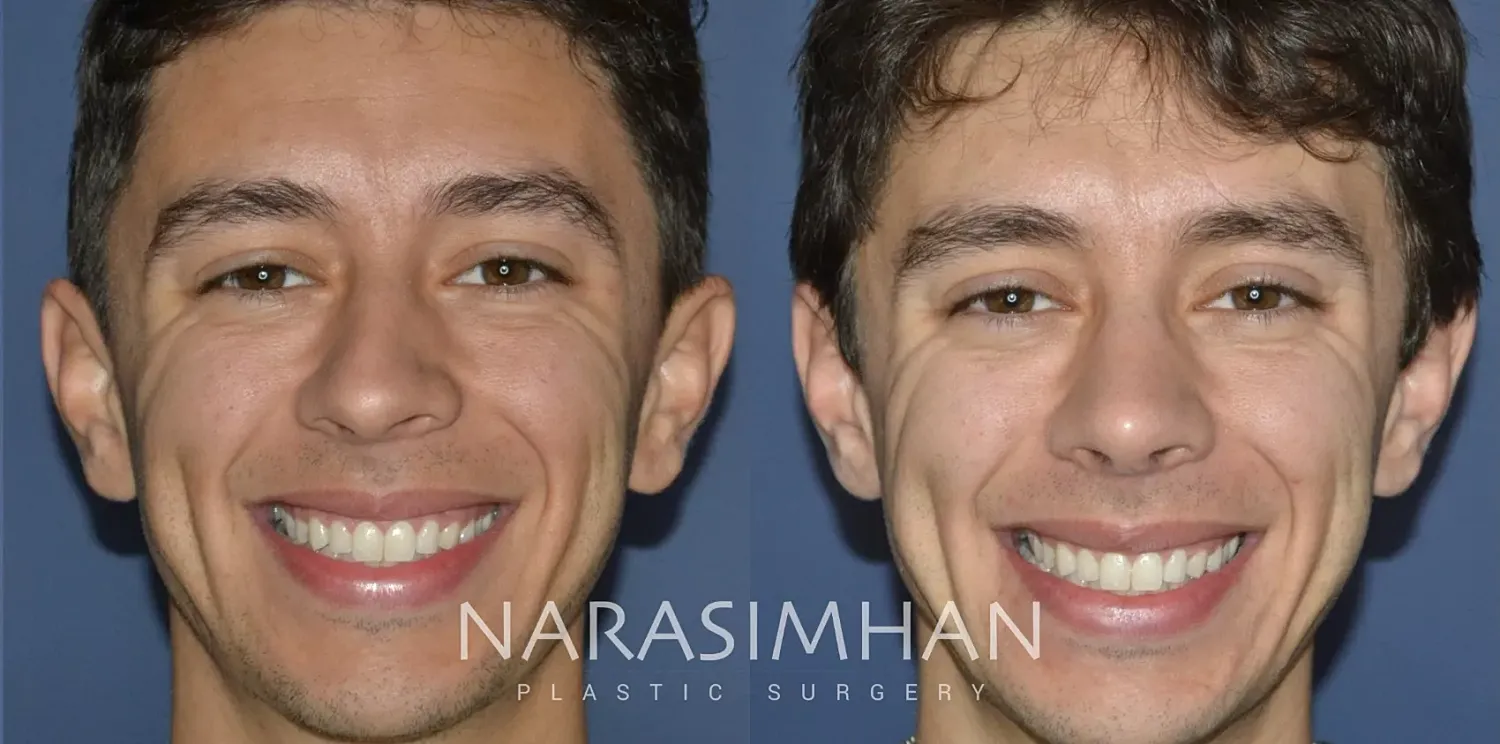 Ethnic Rhinoplasty Before & After