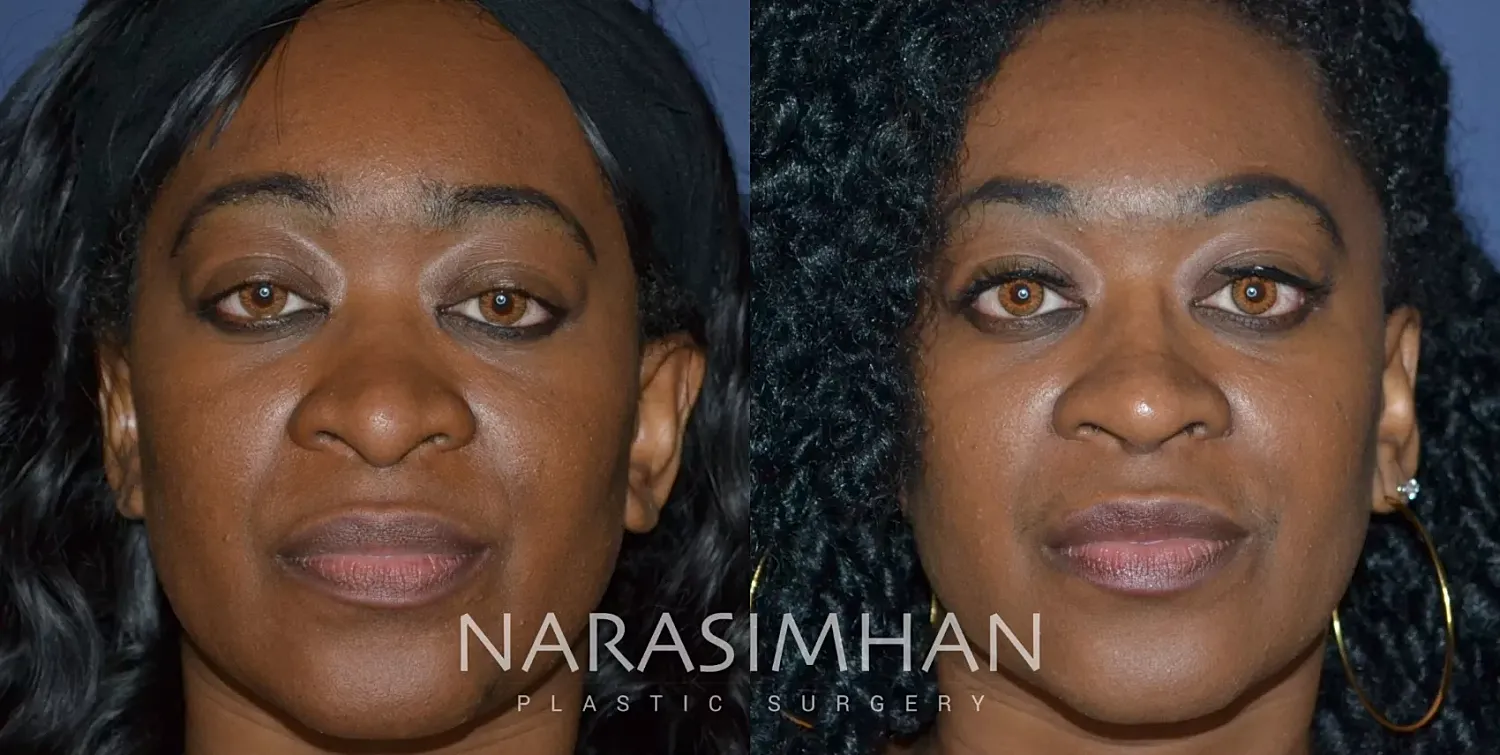 Ethnic Rhinoplasty Before & After