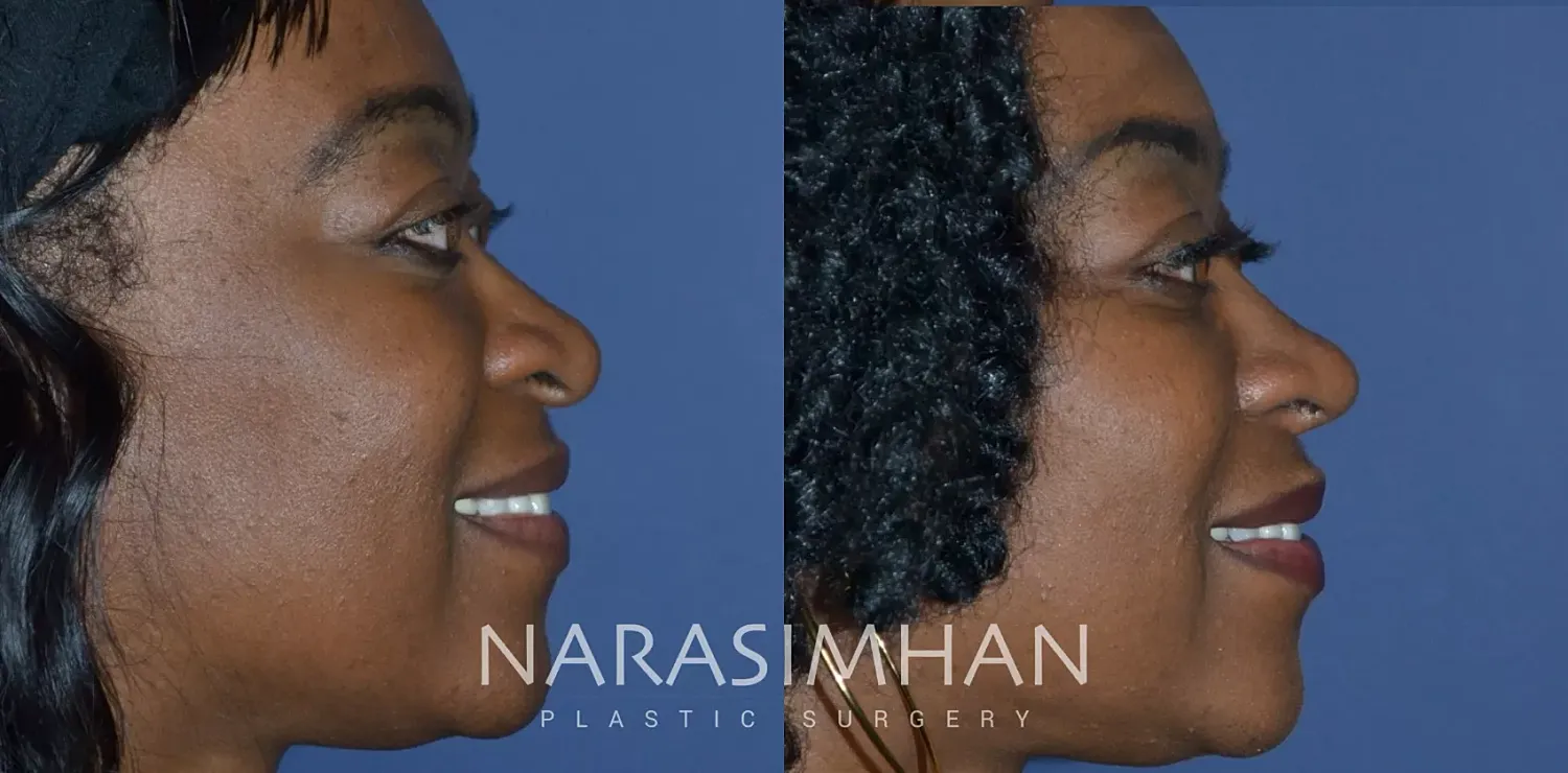 Ethnic Rhinoplasty Before & After