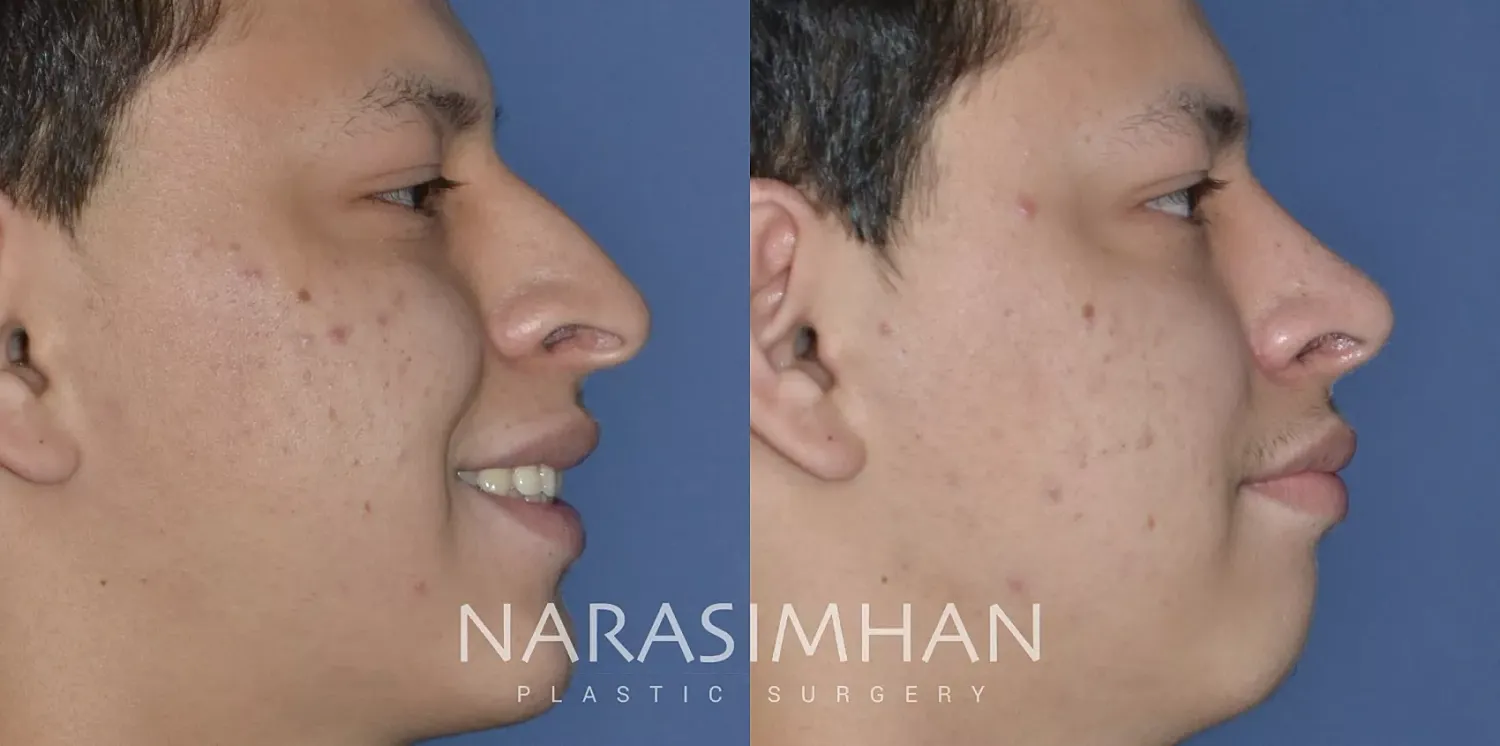 Ethnic Rhinoplasty Before & After