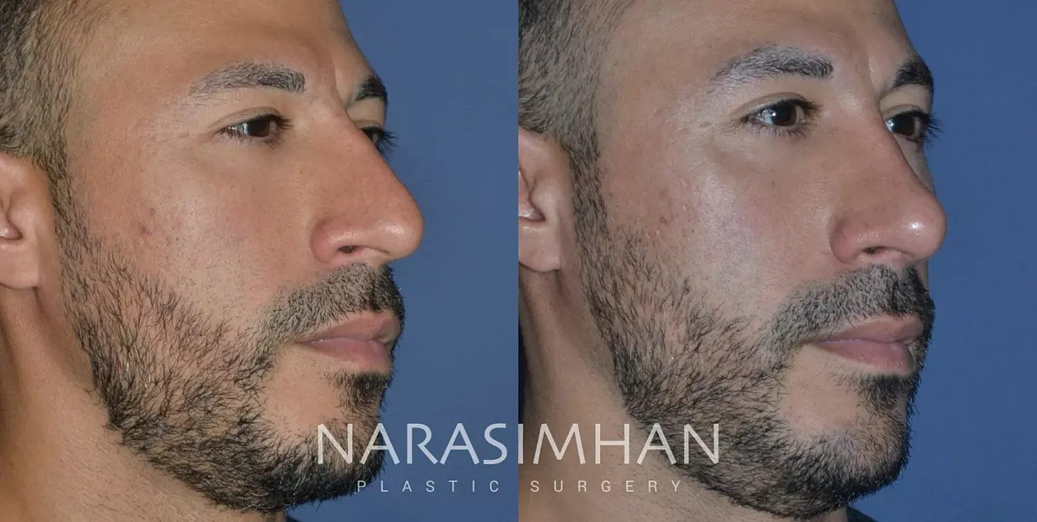 Ethnic Rhinoplasty Before & After