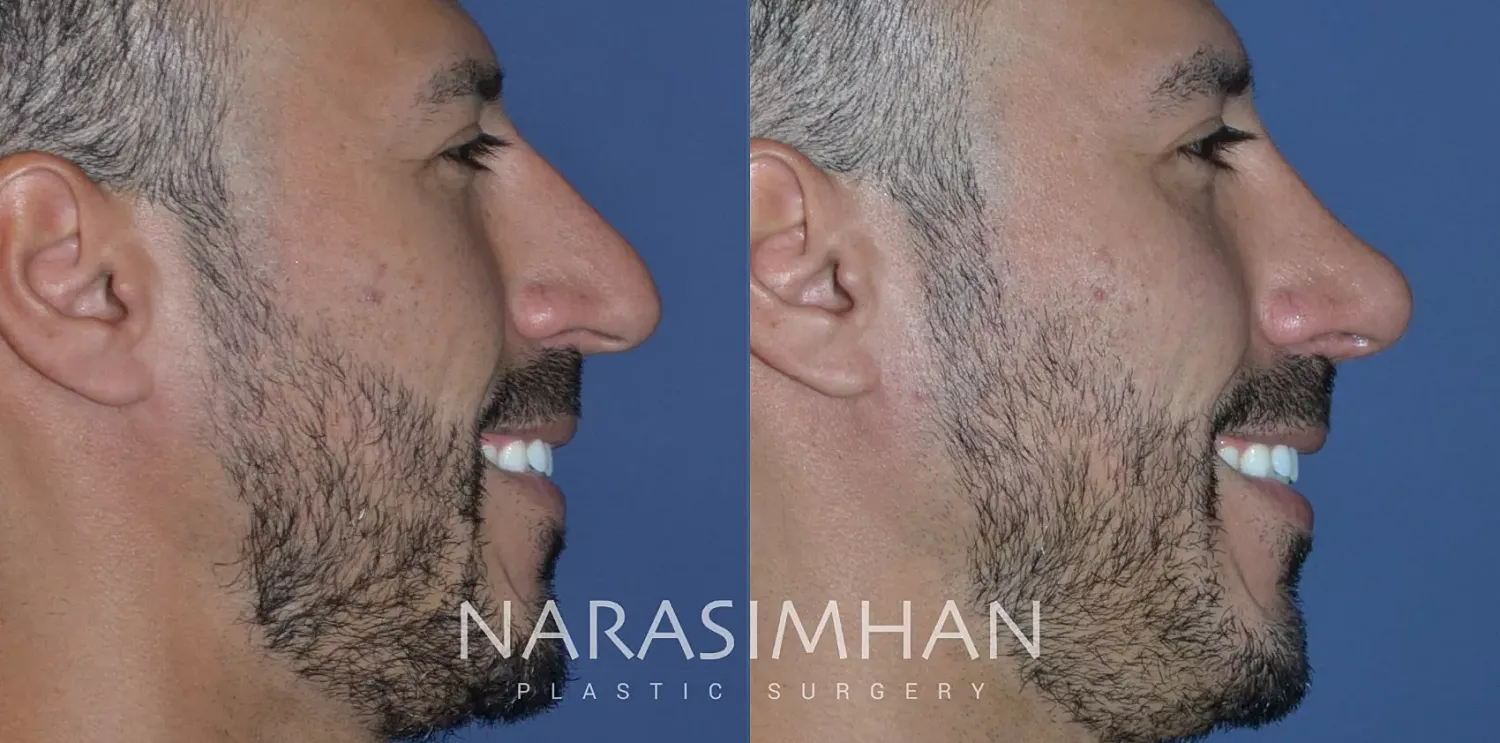 Ethnic Rhinoplasty Before & After
