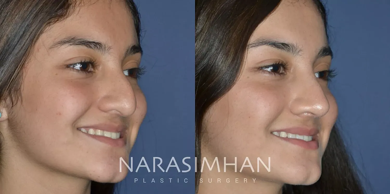 Ethnic Rhinoplasty Before & After