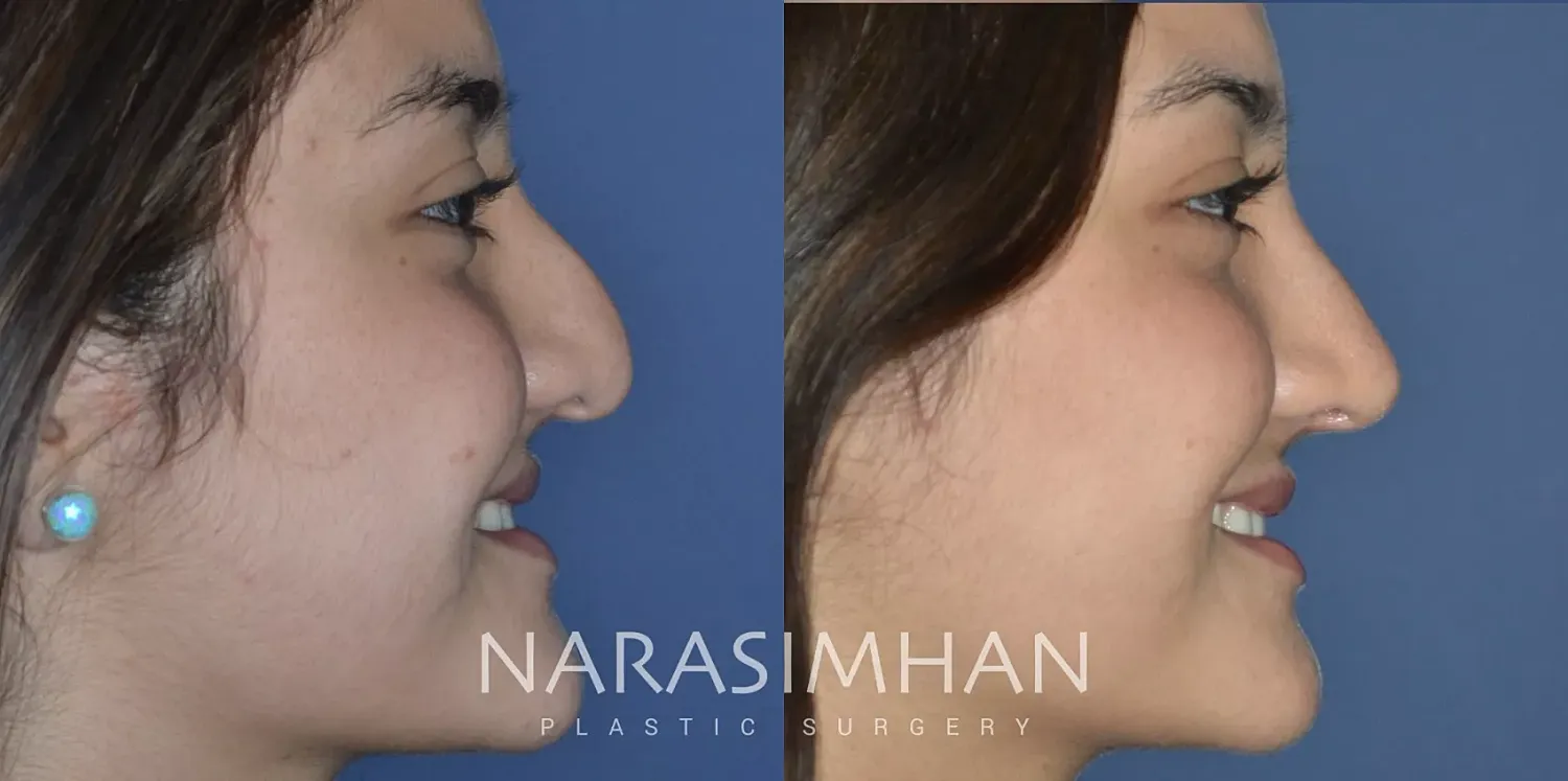 Ethnic Rhinoplasty Before & After