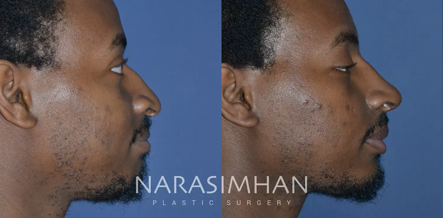 Ethnic Rhinoplasty Before & After