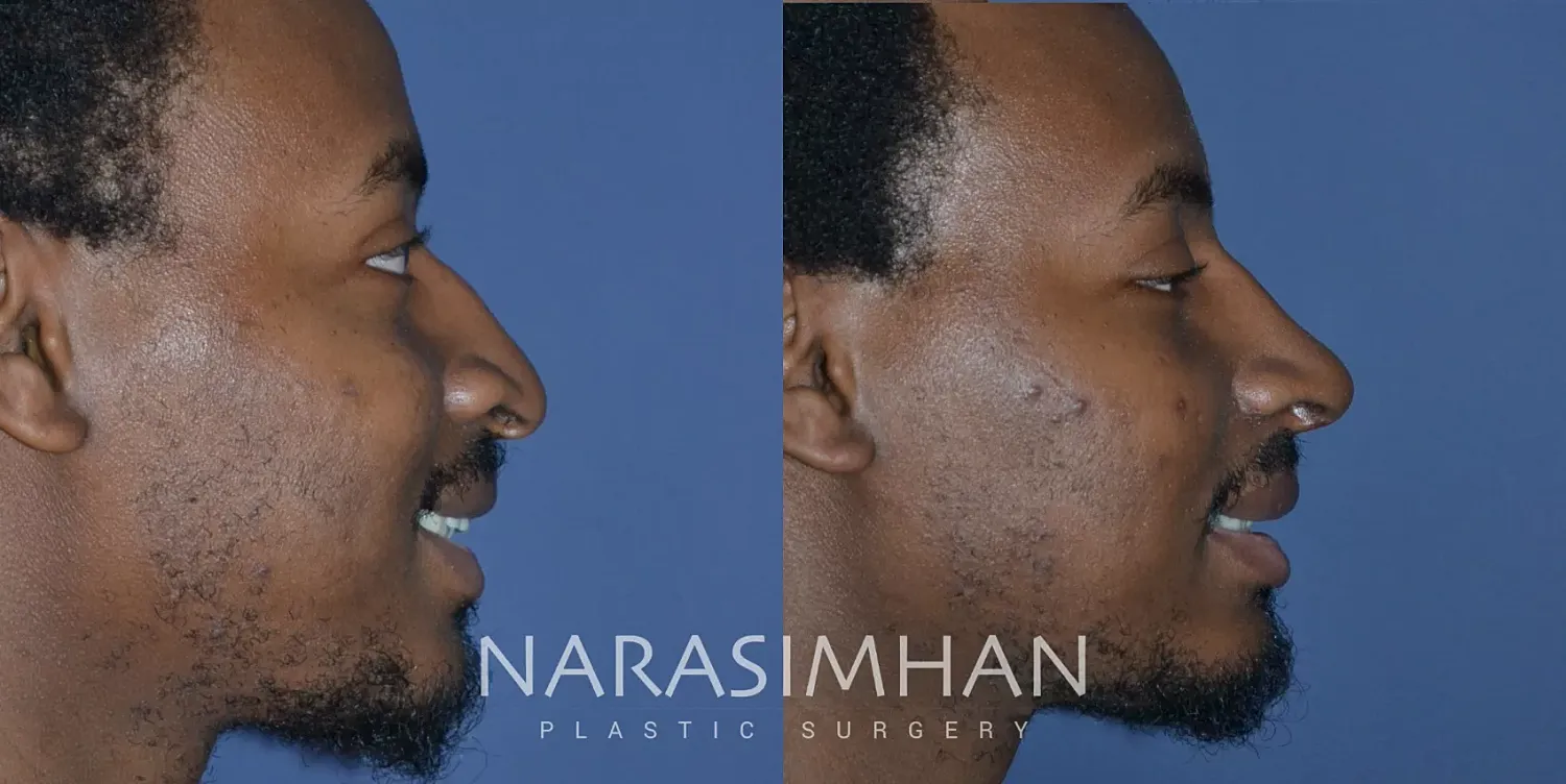 Ethnic Rhinoplasty Before & After
