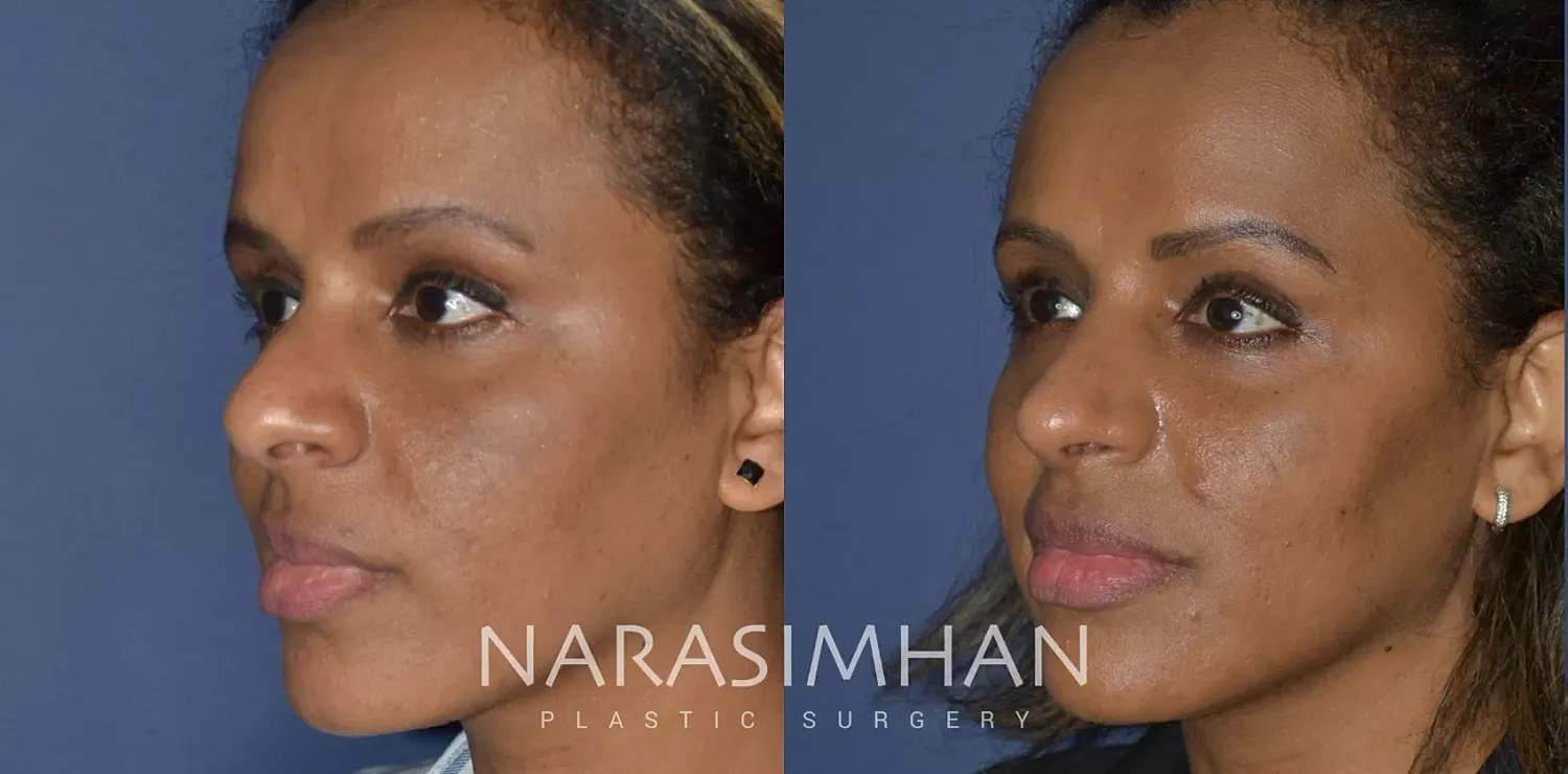Ethnic Rhinoplasty Before & After