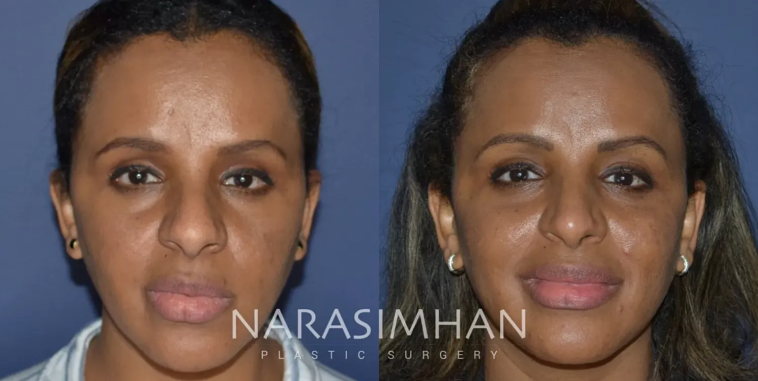 Ethnic Rhinoplasty Before & After
