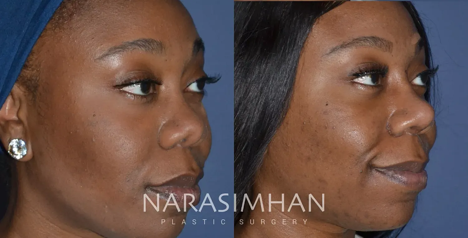 Ethnic Rhinoplasty Before & After