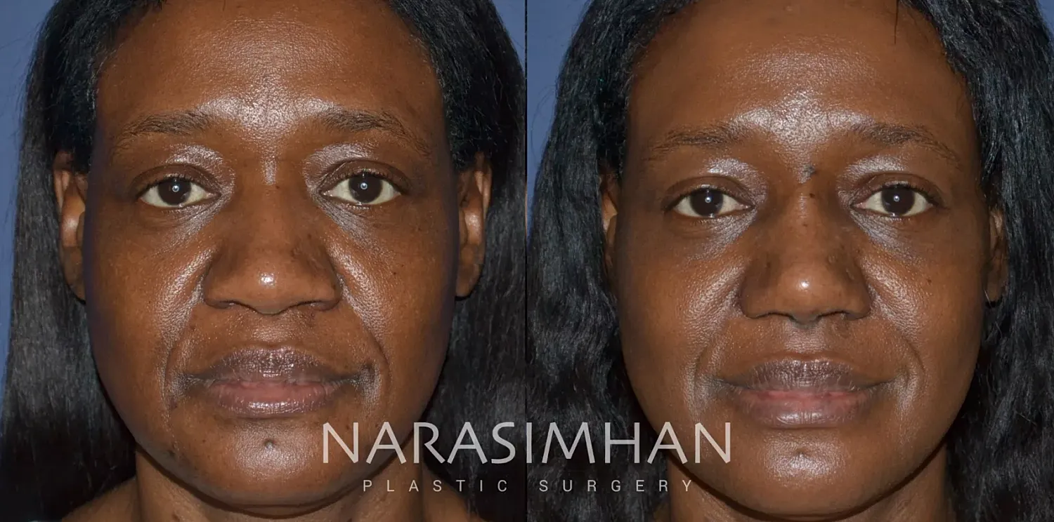 Ethnic Rhinoplasty Before & After