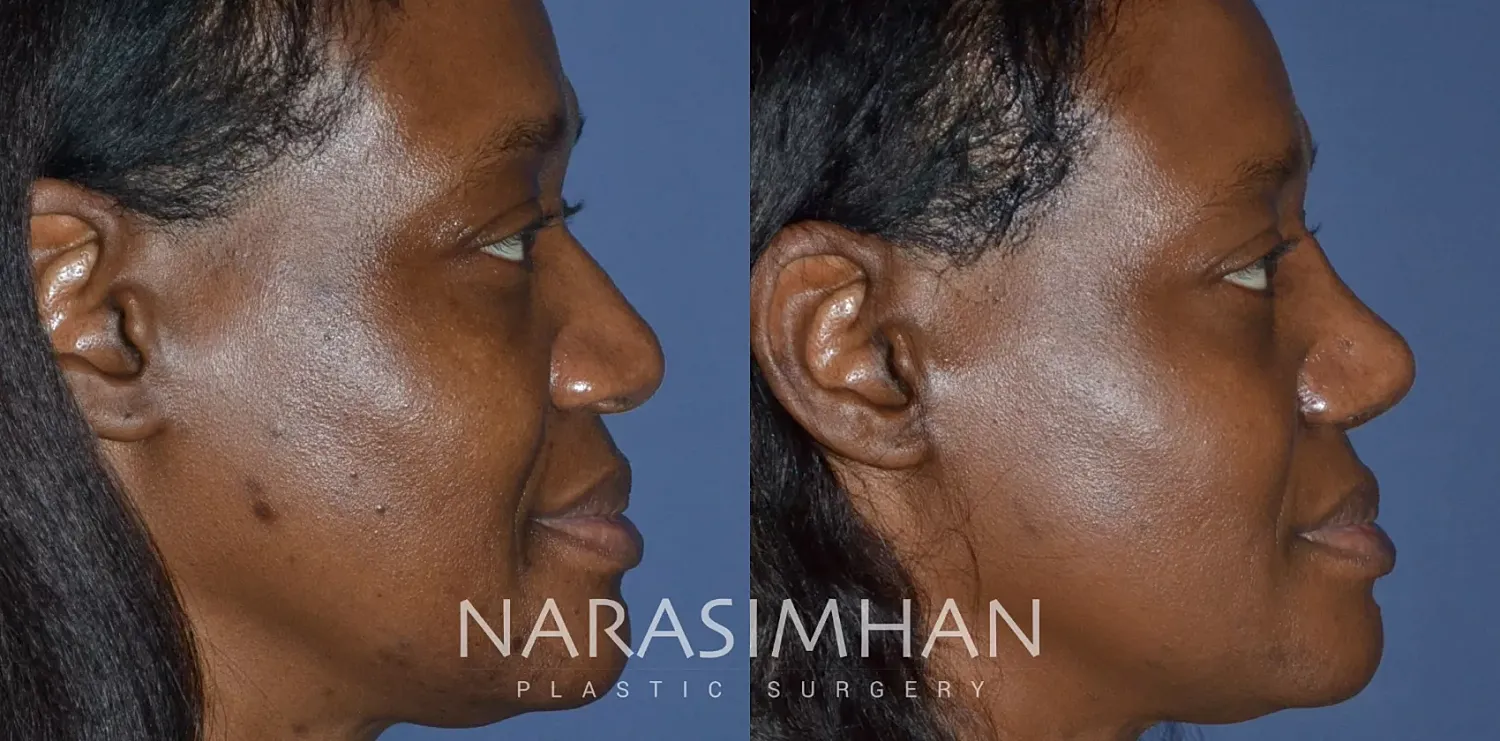 Ethnic Rhinoplasty Before & After