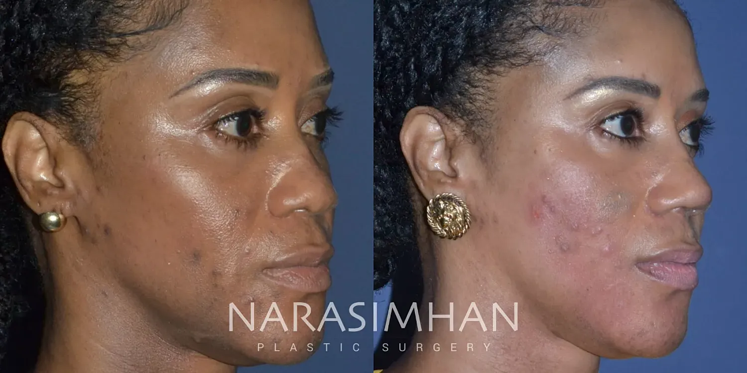 Ethnic Rhinoplasty Before & After